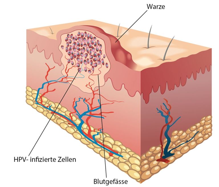 Feigwarzen (Condylomen) FAZ Fachärztezentrum Glatt